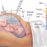 Chọc ối có ảnh hưởng đến thai nhi không