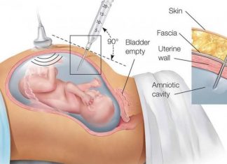 Chọc ối có ảnh hưởng đến thai nhi không