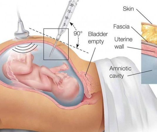 Chọc ối có ảnh hưởng đến thai nhi không